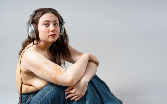 Woman with vitiligo enjoying music in headphones, embracing body positivity