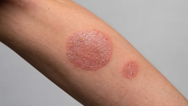 Close-up image of dry round red rash with flaking skin on human arm skin disease symptom
