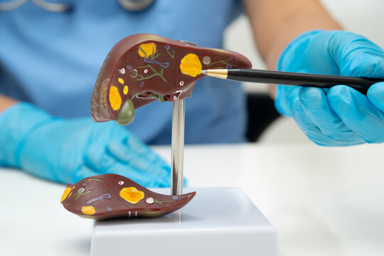 Cirrhosis, Liver cancer, fatty liver, Asian doctor with liver human anatomy model in World Hepatitis Day at hospital.