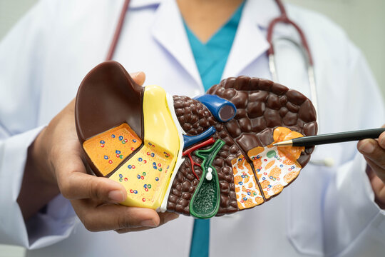 Cirrhosis, Liver cancer, fatty liver, Asian doctor with liver human model.