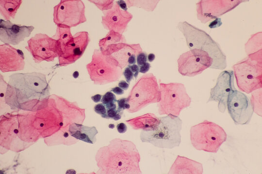 View in microscopic of abnormal human skin cells.Squamous epithelium cells.Superficial and intermediate epithelial cells.Cytology and pathology laboratory department.Magnification 400 X