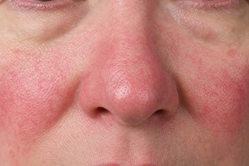 Naklejka premium Rosacea skin condition with visible capillaries on face