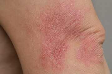 Fototapeta premium Macro of dry scaly eczema patches on human elbow