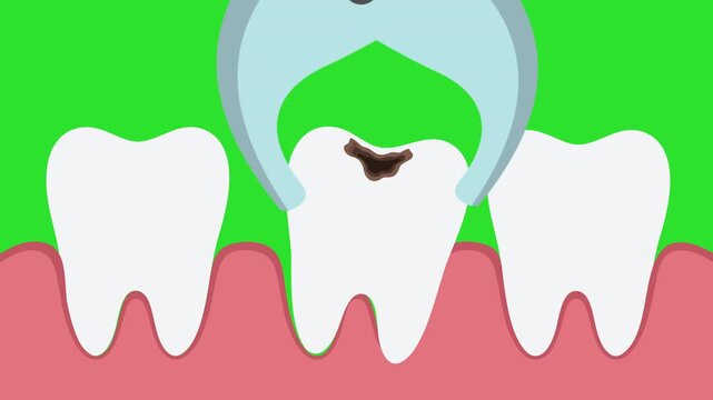 Animated Decayed Tooth Removal Illustration