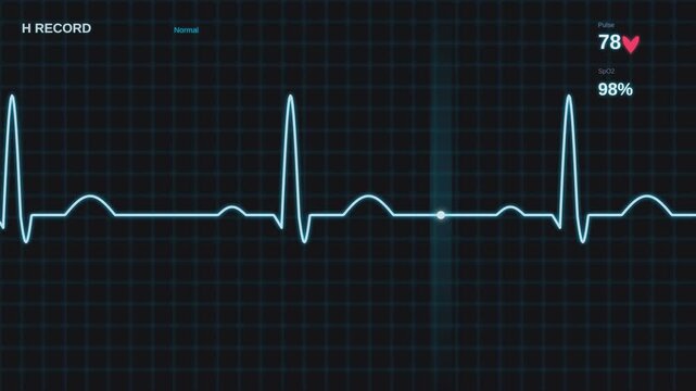 Electrocardiogram ecg heart rate monitor graphic showing normal sinus rhythm healthcare technology.