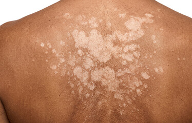 Fototapeta premium Tinea Versicolor Fungal Infection on Dark Skin Back, Hypopigmentation Dermatological Condition