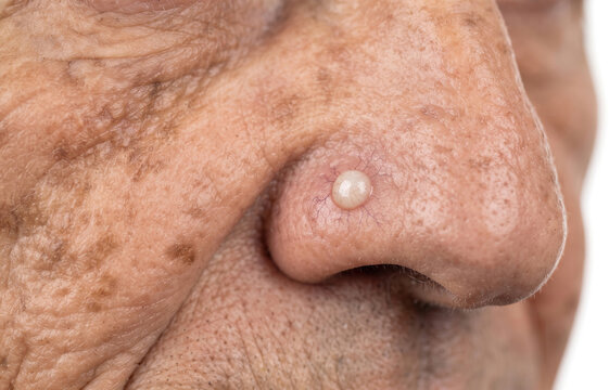 Basal Cell Carcinoma Nodule on Senior Nose, Skin Cancer with Telangiectasia Close Up