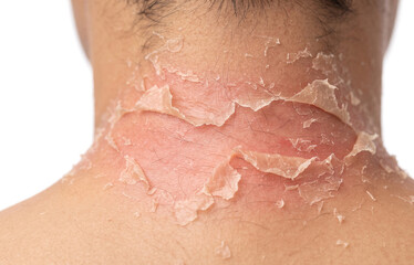 Fototapeta premium Back of human neck with severe sunburn red skin and large peeling flaking skin layers, uv sun damage concept.