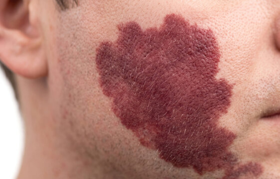 Large Port Wine Stain Birthmark on Male Face, Nevus Flammeus Vascular Malformation Close Up
