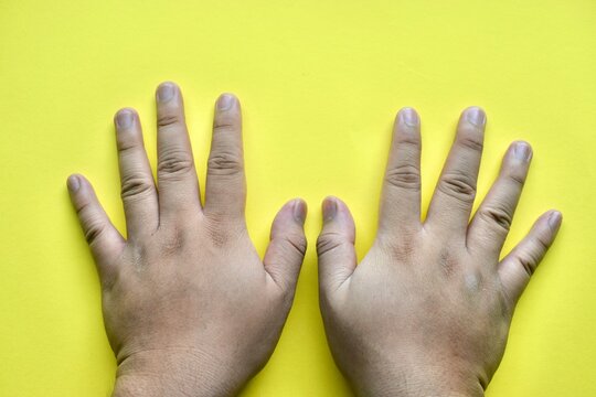 Top view of two male hands lying flat with fingers extended on a bright yellow background.
