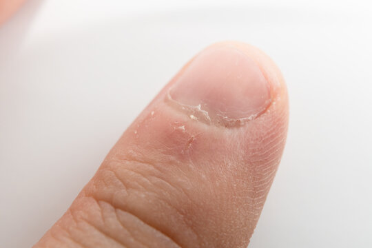 Macro close-up of a man's thumb with hangnail and dry cuticle damage isolated on white background. High quality