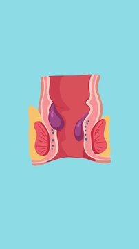 Hemorrhoids consultation with proctologist animation