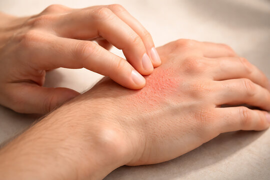 Close up of itchy hand rash being scratched, showing irritated skin condition and allergy discomfort