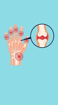 Animation of hand arthritis anatomical illustration