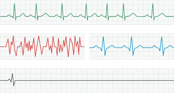 Electrocardiogram Grid Display Set with Normal Heartbeat Rhythm, Ventricular Fibrillation Arrhythmia Waves, Bradycardia Pulse Rate, and Flatline Cardiac Arrest Vector Diagrams