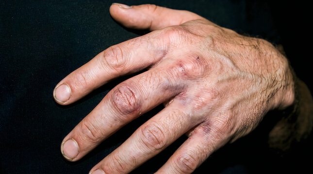 Injured Hand with Bruises and Swelling on Knuckles
