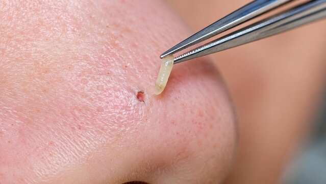 Close-up extraction of whitehead pimple acne blemish from facial skin using metal tweezers tool