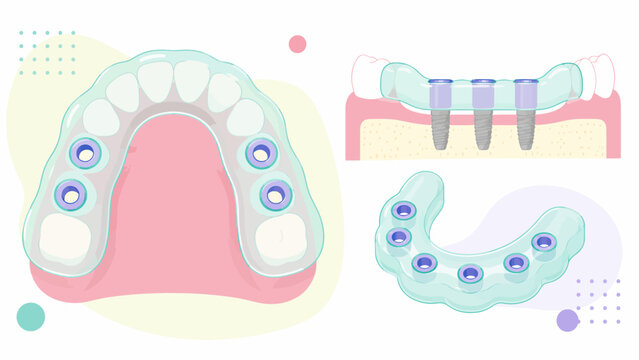 Dental Implant Surgical Guide for Full Arch Placement