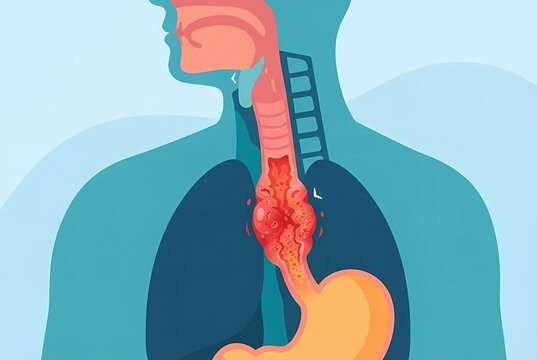 Esophagitis illustration showing inflamed esophagus with irritation between throat and stomach in human torso anatomy
