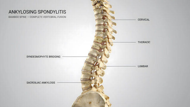Medical illustration of a human spine with ankylosing spondylitis