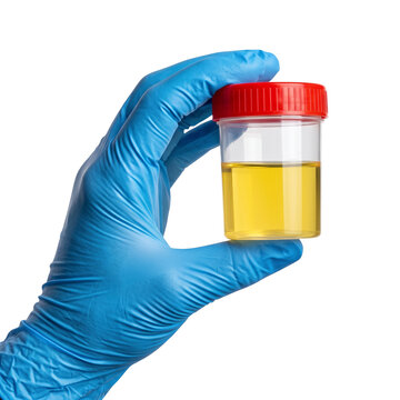 Medical sample container with urine held by gloved hand, isolated on white background.
