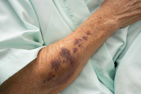 Ecchymosis, elderly bleeding on her arm after taking aspirin.