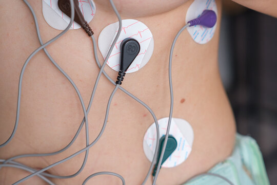 Holter monitoring electrodes are placed on a patient's torso with wires connected, illustrating a medical environment for heart health assessment