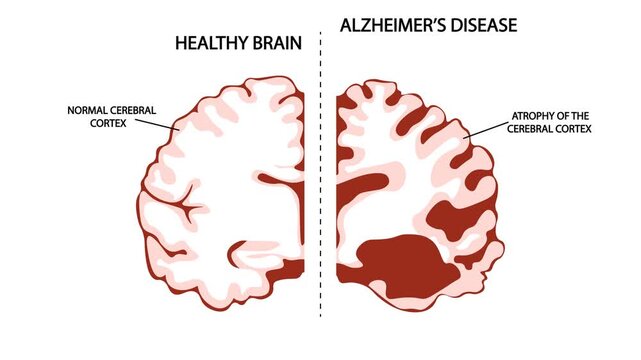 Medical vector illustration and animation comparing a healthy brain with Alzheimer&rsquo;s disease, showing cerebral cortex atrophy and neurodegenerative changes, highlighting dementia, vascular dementia