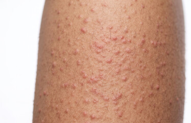 Fototapeta premium Close up of keratosis pilaris strawberry skin tiny bumps on hair follicles of human leg.
