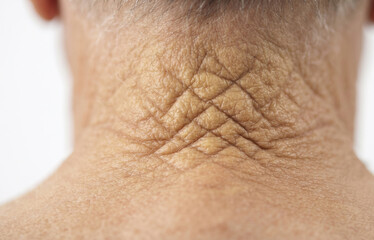 Fototapeta premium Cutis Rhomboidalis Nuchae on Senior Neck, Severe Sun Damage and Deep Wrinkles Close Up