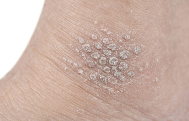 Fototapeta premium Cluster of Viral Warts and Keratotic Papules on Skin, HPV Dermatological Condition Close Up