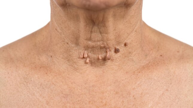 Multiple skin tags and acrochordons on senior woman neck closeup