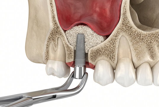 3D Medical Illustration of Sinus Lift Dental Implant Surgery