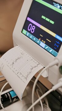 Medical monitor shows fetal heart rate and contractions with paper printout in healthcare setting.