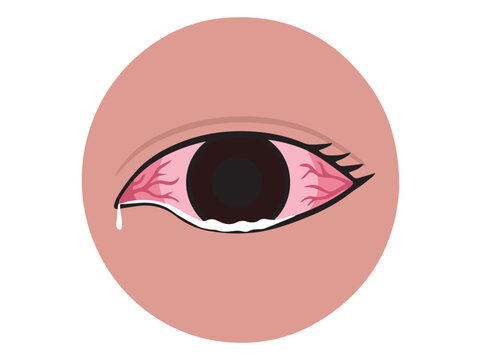 Allergy Eye Disease and Disorder illustration