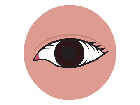 Trichiasis Eye Clip Art Illustration