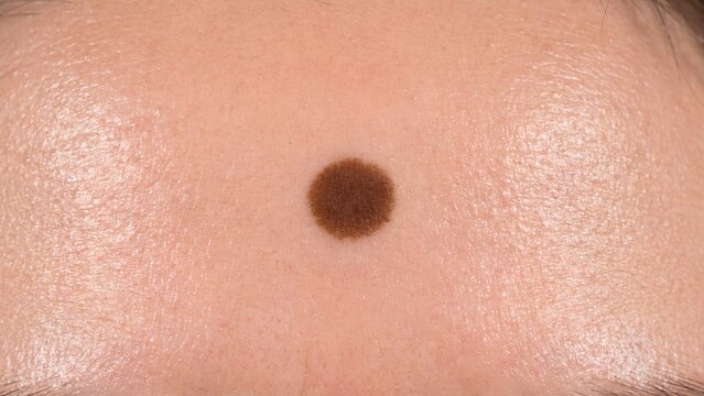Close-up of a pigmented melanocytic nevus on human forehead skin