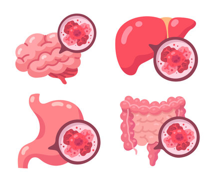 Medical visualization of diseased human organs brain, liver, stomach, and intestines with magnified pathology.