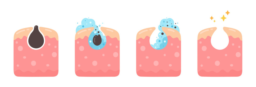 Detailed illustration of skin pore cleansing process, demonstrating effective blackhead removal and achieving clear, healthy skin