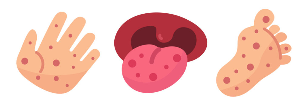 Common symptoms of hand, foot, and mouth disease illustrated on skin, tongue, palm, and sole