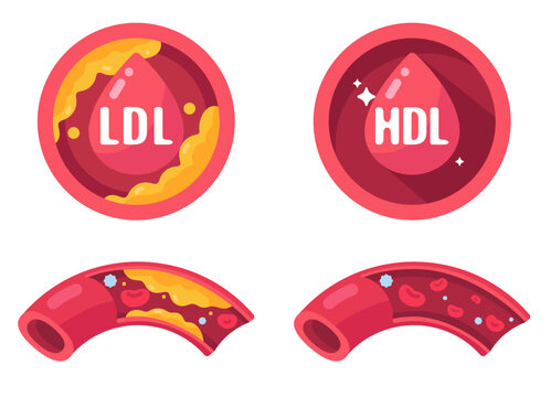 Understanding LDL and HDL Cholesterol Impact on Healthy and Unhealthy Blood Vessels