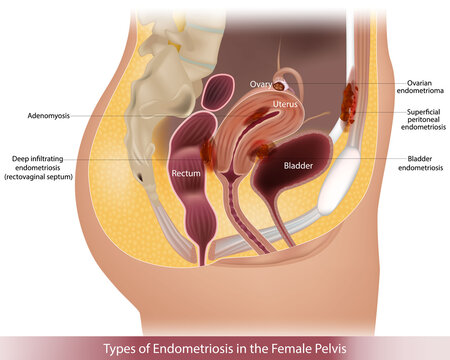 Endometriosis Types in Female Pelvic Anatomy. Cross-sectional anatomical diagram of the female reproductive system for medical education 