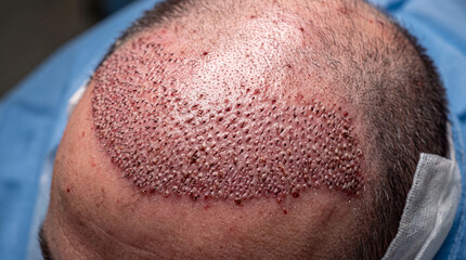 Naklejka premium Detailed view of a bald scalp post hair restoration procedure with visible micro-channels and some blood spots