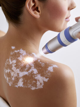 Vitiligo skin treatment shoulder patch laser therapy skin condition pigmentation loss medical procedure human skin back view neck dermatology