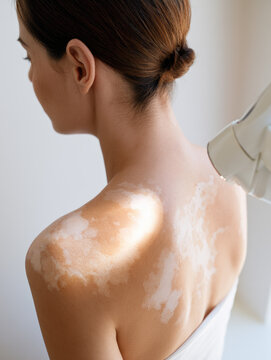 Vitiligo skin treatment back view shoulder upper back light beam