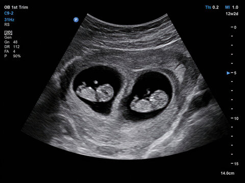 Twin Pregnancy Ultrasound Showing Two Fetuses in First Trimester