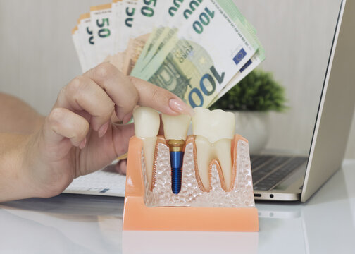 Financial investment in oral health. Expensive dentistry concept with artificial tooth implant model and european currency.