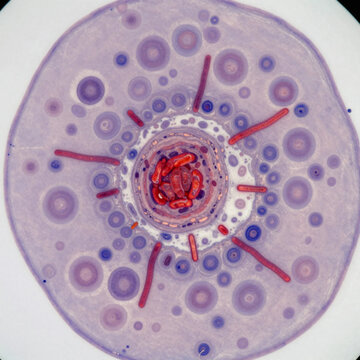 Lung histopathology (Ziehl-Neelsen stain) showing a caseating granuloma with a central necrotic area (caseous necrosis)