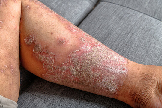 Close-up of inflamed dry scaly skin on a human leg, A chronic skin condition with redness, irritation, and flaky texture for healthcare and dermatology
