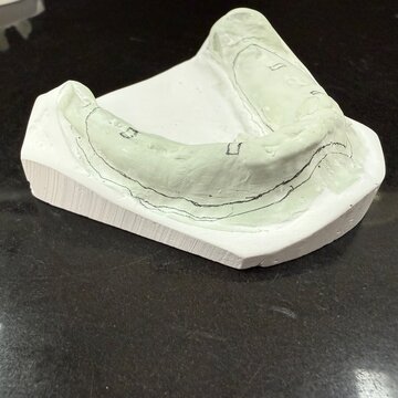 Dental lower edentulous cast